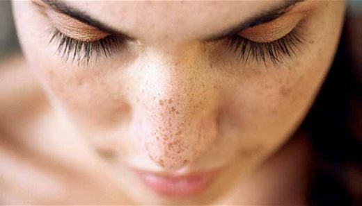 Güneş Lekelerine Karbonat